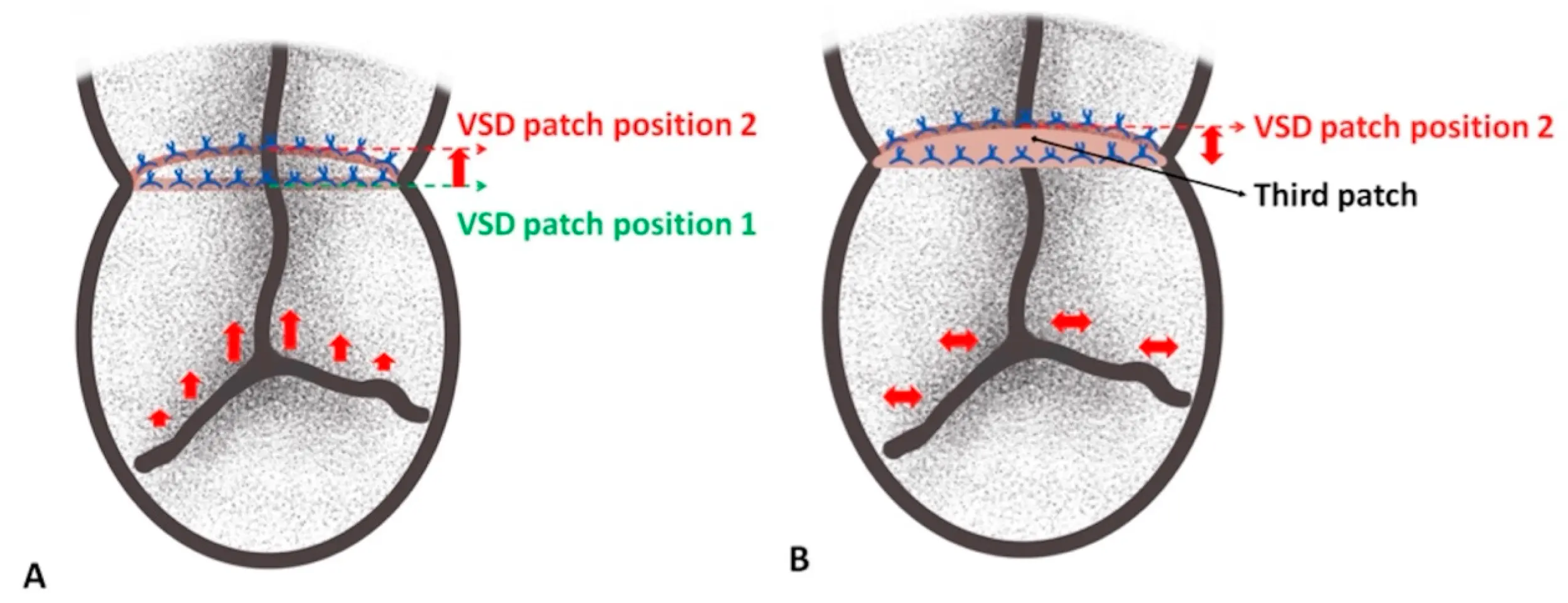 SCHD | Free Full-Text | Case Report: A Third Patch as a Saviour in an ...