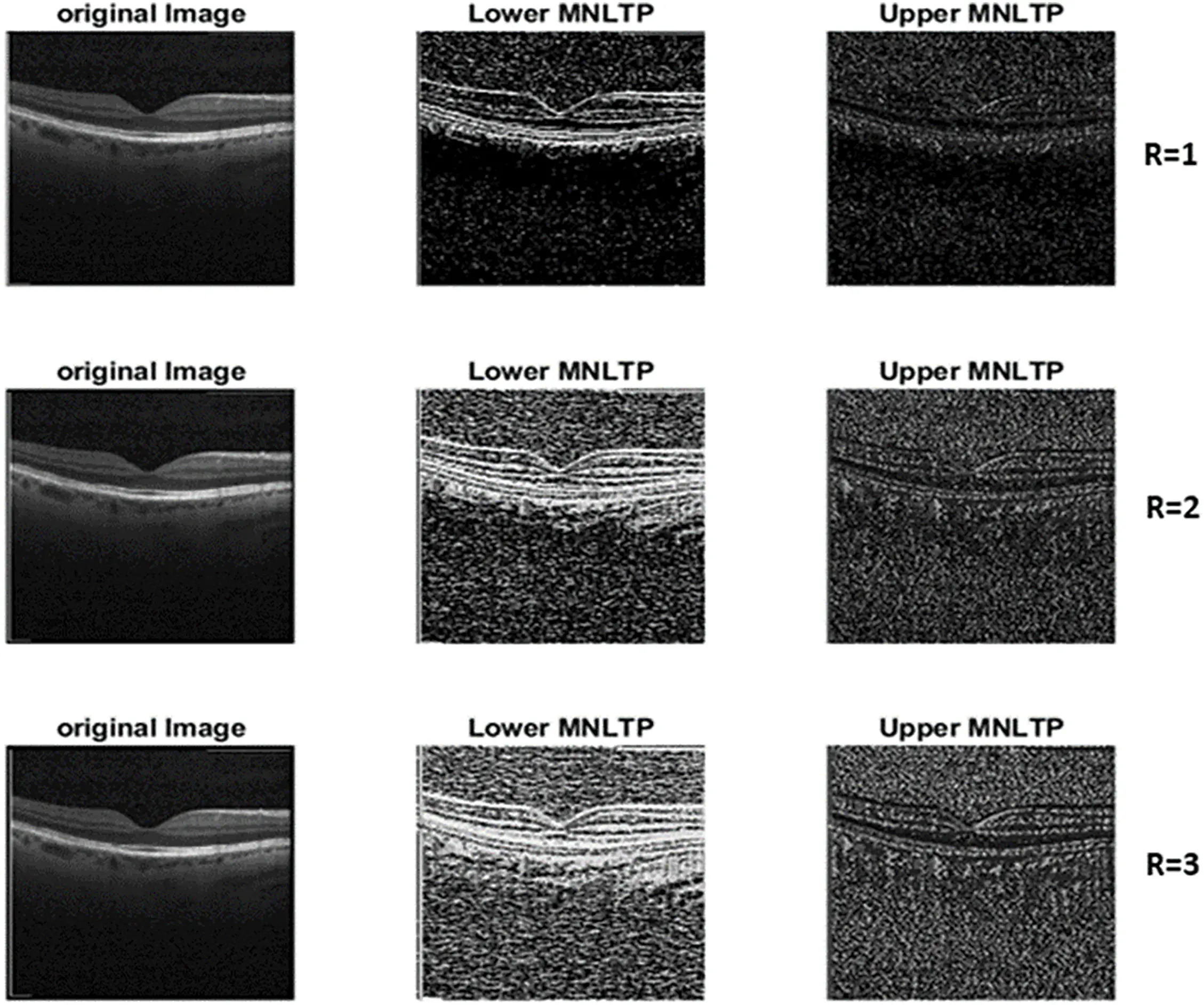 CMC | Free Full-Text | Hybrid MNLTP Texture Descriptor and PDCNN-Based ...