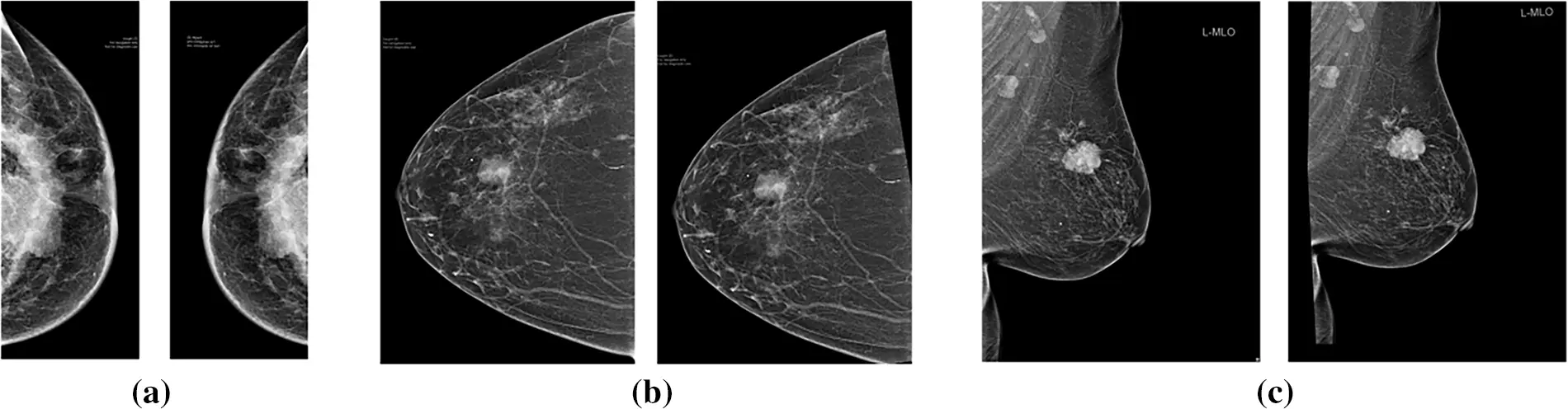 CMC | Free Full-Text | Advancing Breast Cancer Molecular Subtyping: A ...