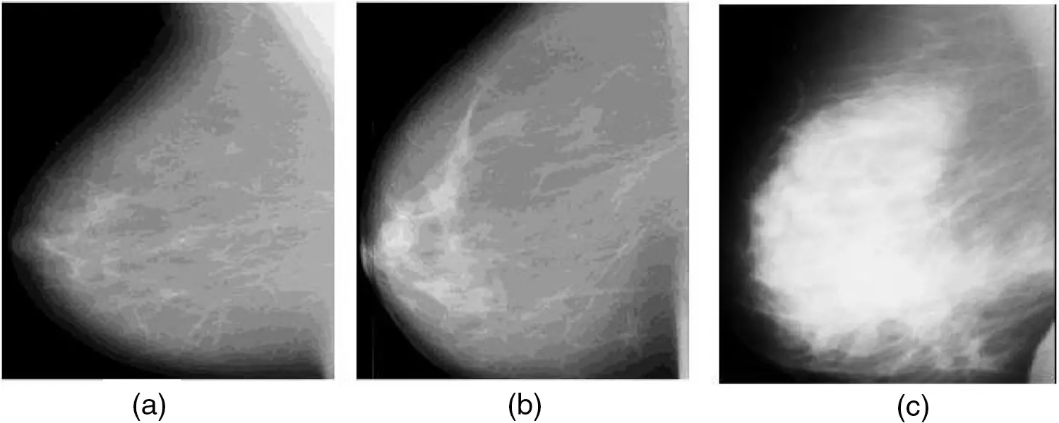IASC | Free Full-Text | Cancer Regions in Mammogram Images Using ANFIS ...