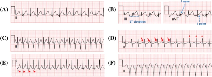 Junctional Ectopic Tachycardia Ecg