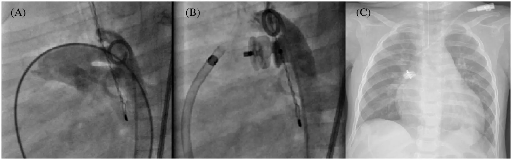 Using Av Plug Before Embalming Efficacy, Safety and Characteristics of the Amplatzer Vascular Plug II ...