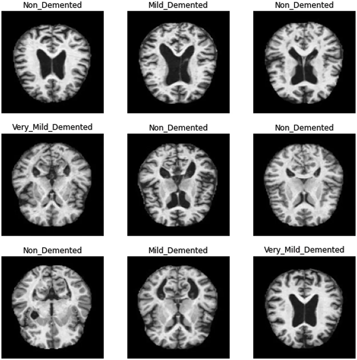 CMC | Free Full-Text | A Deep Learning for Alzheimer’s Stages Detection ...
