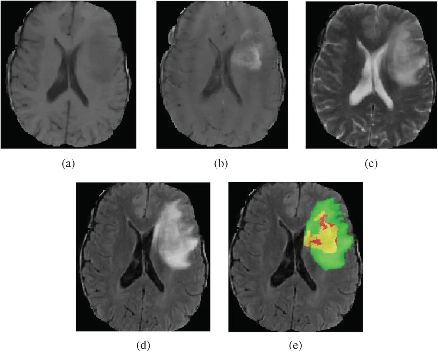 MRI Brain Tumor Segmentation Using 3D U-Net with Dense Encoder Blocks ...