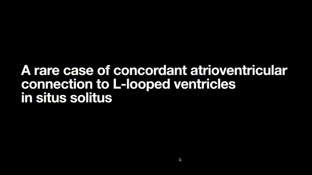 A Rare Case of Concordant Atrioventricular Connection to L-Looped Ventricles in Situs Solitus: 4-Dimensional Magnetic Resonance Imaging and 3D Printing