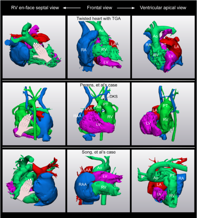 Disharmonious Ventricular Relationship and Topology for the Given Atrioventricular Connections. Contemporary Diagnostic Approach Using 3D Modeling and Printing
