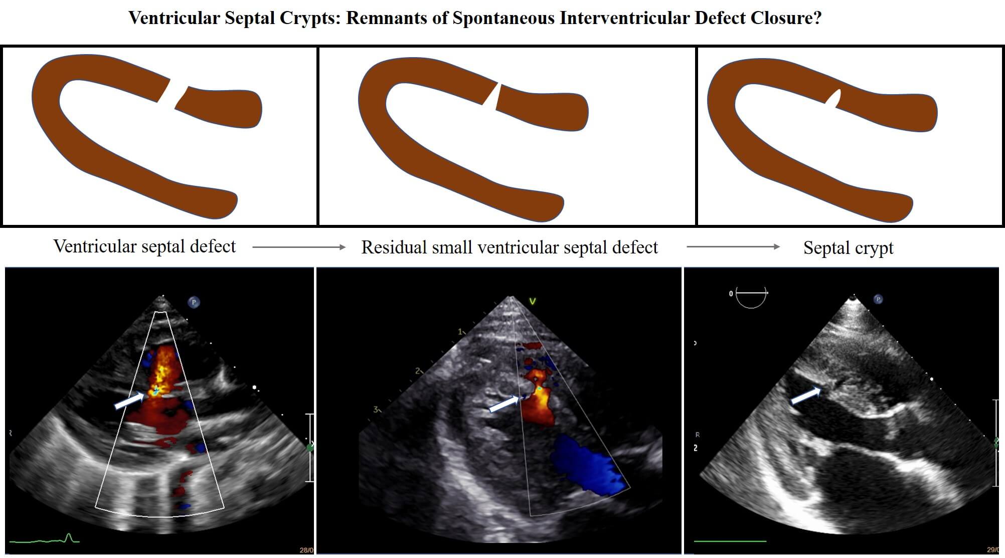 Ventricular Septal Crypts: Remnants of Spontaneous Interventricular Defect Closure?