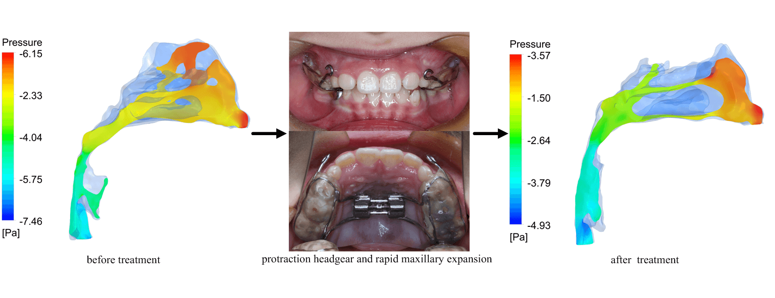 Computational Fluid Dynamics Analysis of Upper Airway Changes after Protraction Headgear and Rapid Maxillary Expansion Treatment