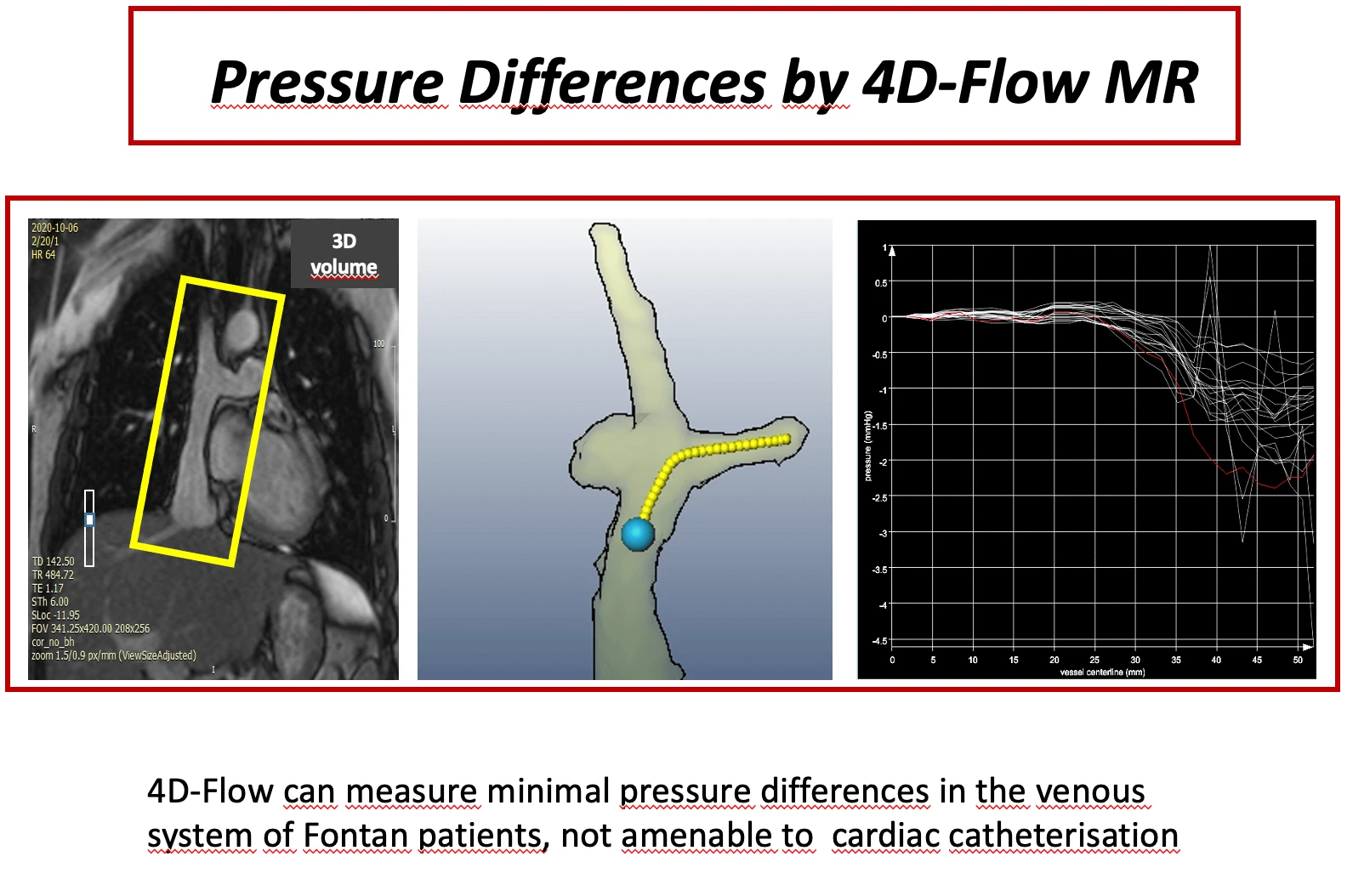 Minor Pressure Differences within the Fontan-Anastomosis in Patients with Total Cavopulmonary Connection by 4D-Flow Magnetic Resonance Imaging