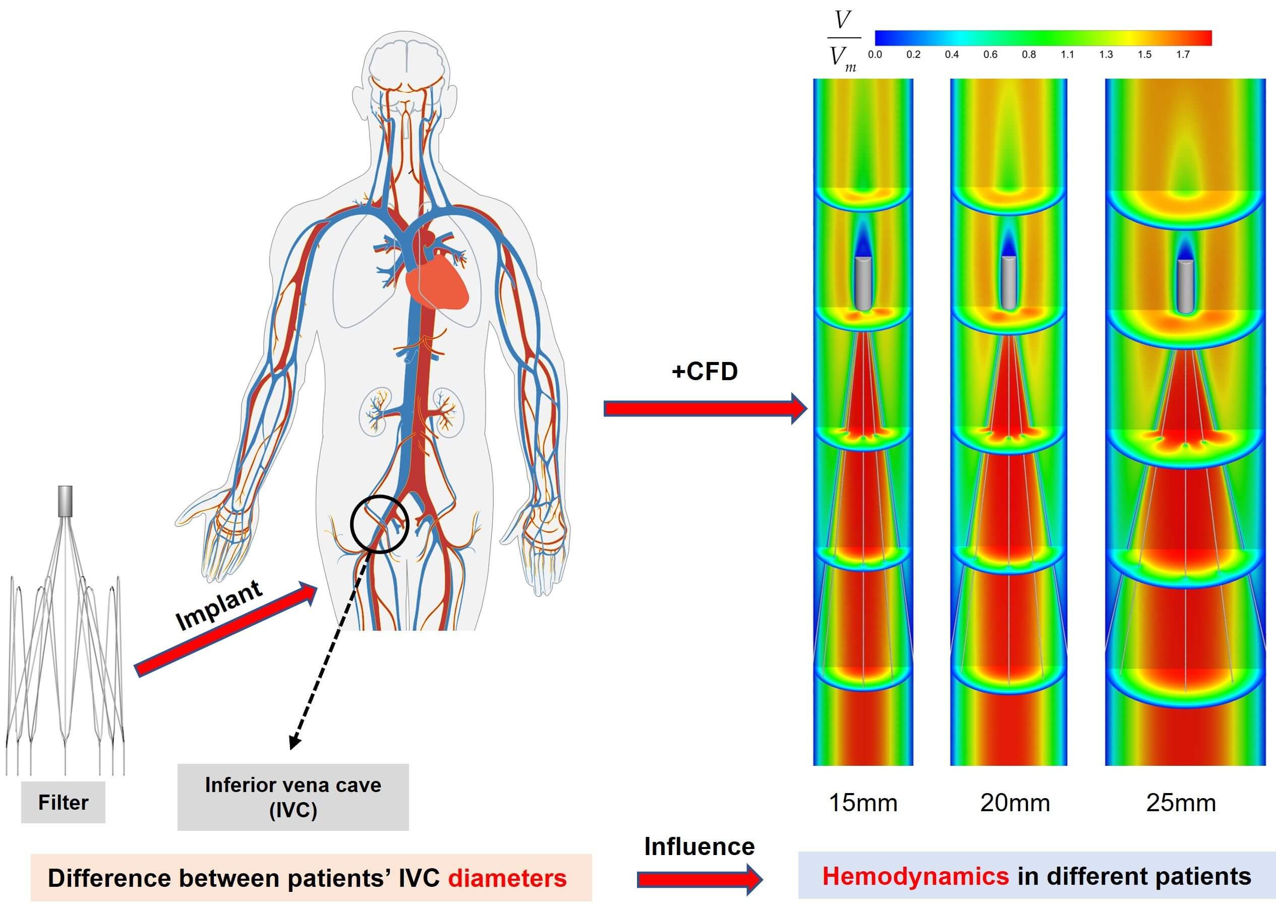CFD Study on Hemodynamic Characteristics of Inferior Vena Cava Filter Affected by Blood Vessel Diameter