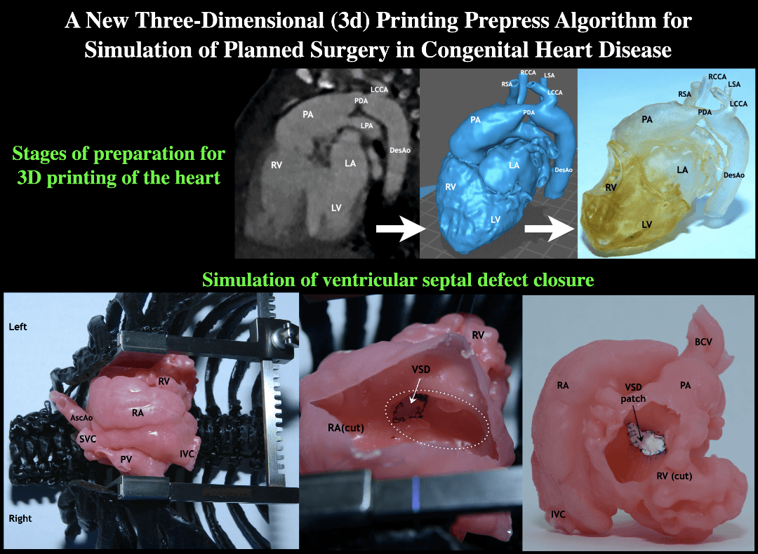 A New Three-Dimensional (3D) Printing Prepress Algorithm for Simulation of Planned Surgery for Congenital Heart Disease