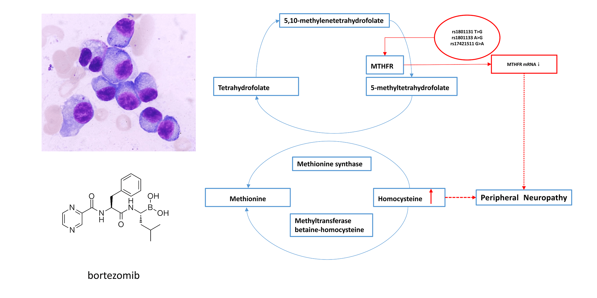 A genetic variant study of bortezomib-induced peripheral neuropathy in Chinese multiple myeloma patients